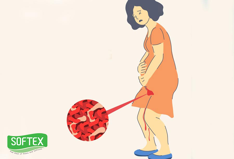دلایل خونریزی در دوران بارداری